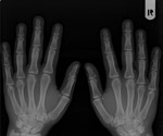 Röntgenkuva ihmisen käsistä.